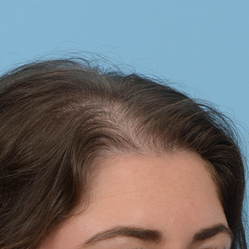 Prp Before and After | Dr. Jeffrey Wise