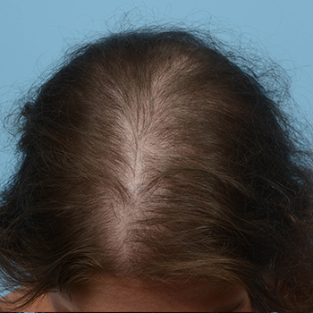 Prp Before and After | Dr. Jeffrey Wise