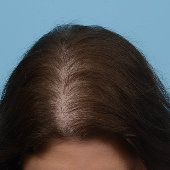 Prp Before and After | Dr. Jeffrey Wise