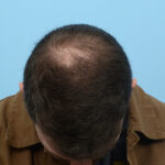 Prp Before and After | Dr. Jeffrey Wise