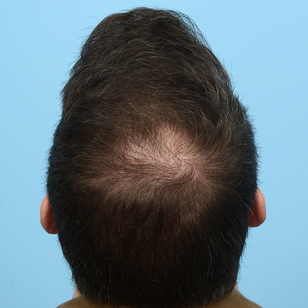 Prp Before and After | Dr. Jeffrey Wise