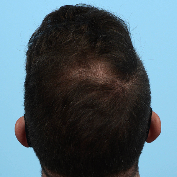Prp Before and After | Dr. Jeffrey Wise
