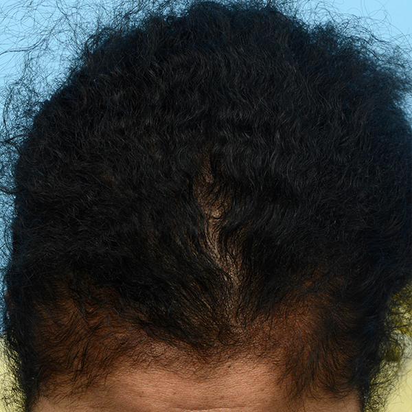 Prp Before and After | Dr. Jeffrey Wise