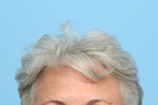 Prp Before and After | Dr. Jeffrey Wise