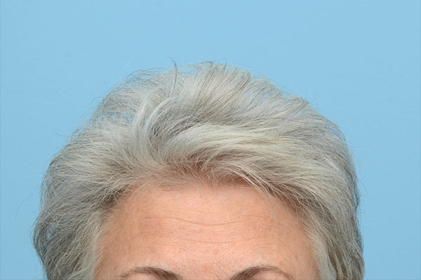Prp Before and After | Dr. Jeffrey Wise