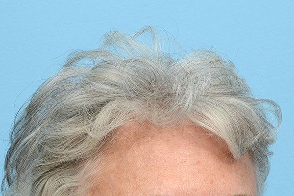 Prp Before and After | Dr. Jeffrey Wise