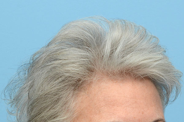 Prp Before and After | Dr. Jeffrey Wise