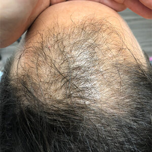 Prp Before and After | Dr. Jeffrey Wise