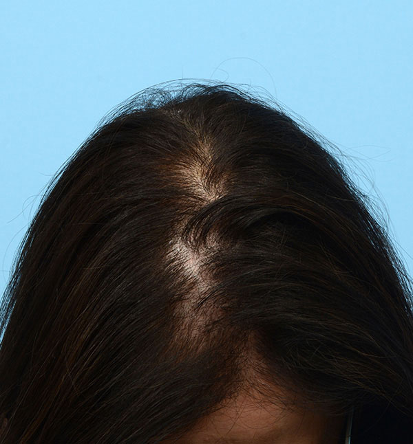 Prp Before and After | Dr. Jeffrey Wise