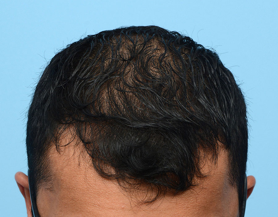 Prp Before and After | Dr. Jeffrey Wise