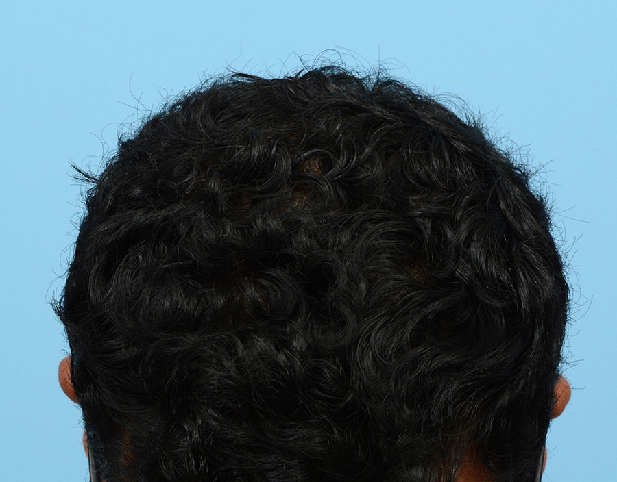 Prp Before and After | Dr. Jeffrey Wise