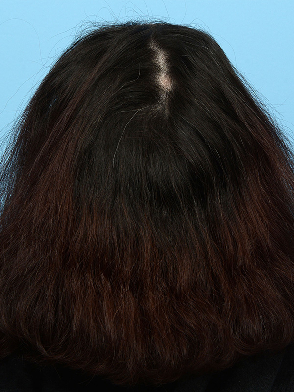 Prp Before and After | Dr. Jeffrey Wise