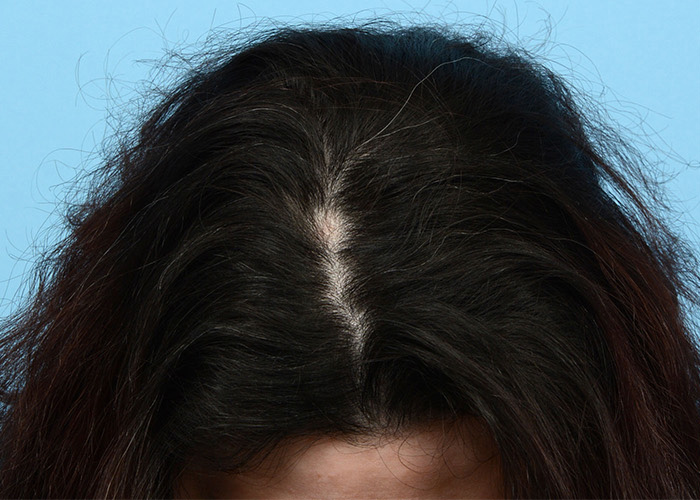 Prp Before and After | Dr. Jeffrey Wise