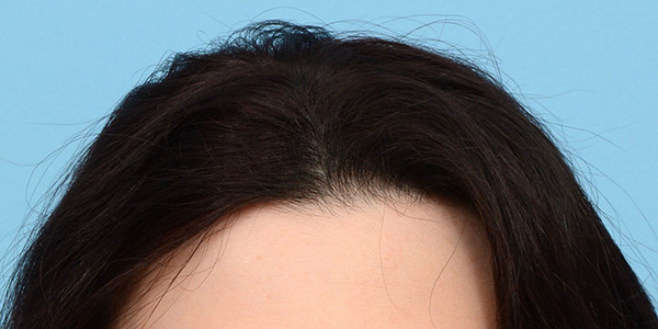 Prp Before and After | Dr. Jeffrey Wise