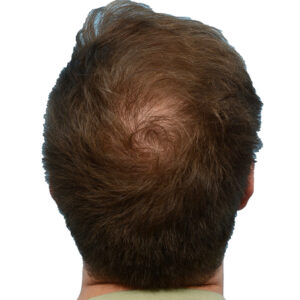Prp Patient 28 After