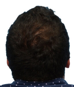 Prp Before and After | Dr. Jeffrey Wise