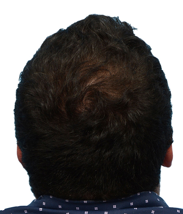 Prp Before and After | Dr. Jeffrey Wise