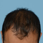 Prp Before and After | Dr. Jeffrey Wise