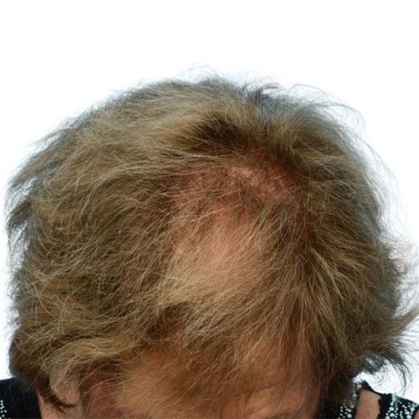 Prp Before and After | Dr. Jeffrey Wise