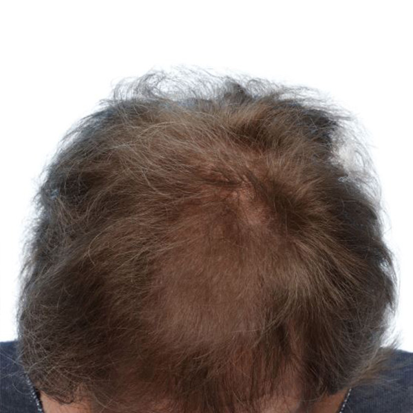 Prp Before and After | Dr. Jeffrey Wise