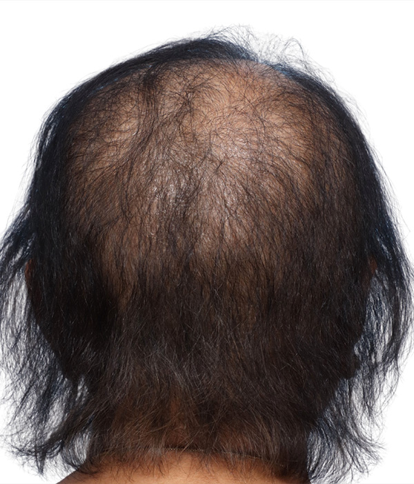 Prp Before and After | Dr. Jeffrey Wise