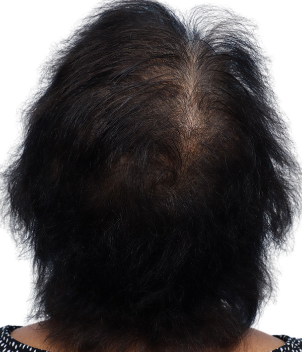Prp Before and After | Dr. Jeffrey Wise