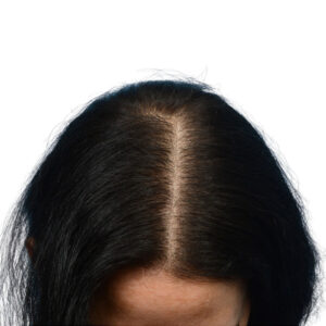 Prp Patient 34 Before