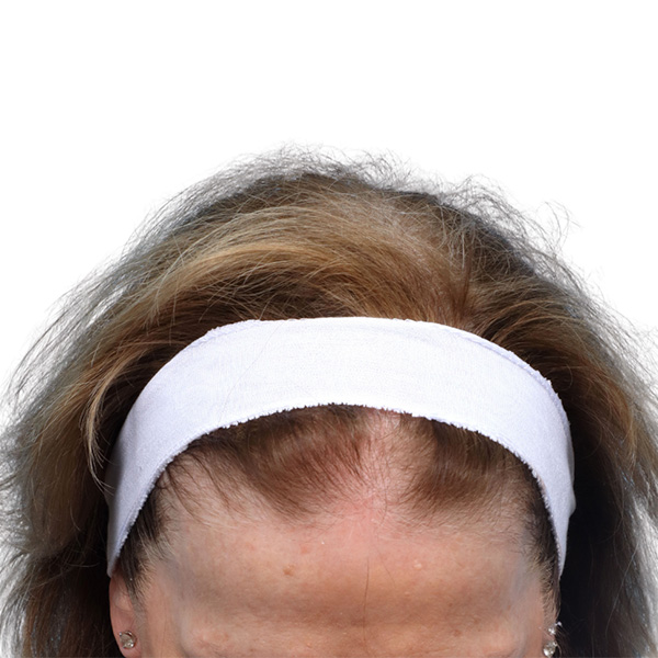 Prp Before and After | Dr. Jeffrey Wise