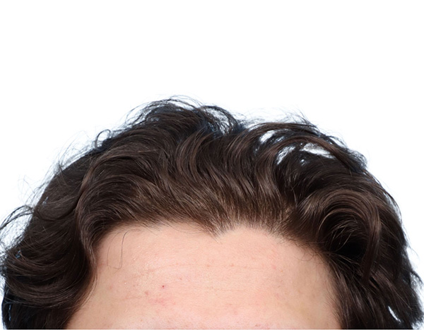 Prp Before and After | Dr. Jeffrey Wise