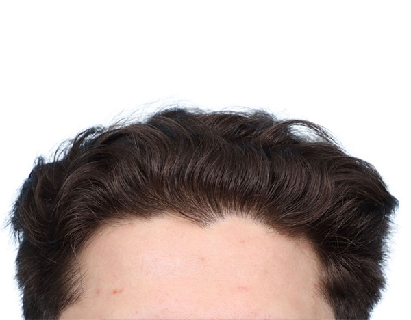 Prp Before and After | Dr. Jeffrey Wise