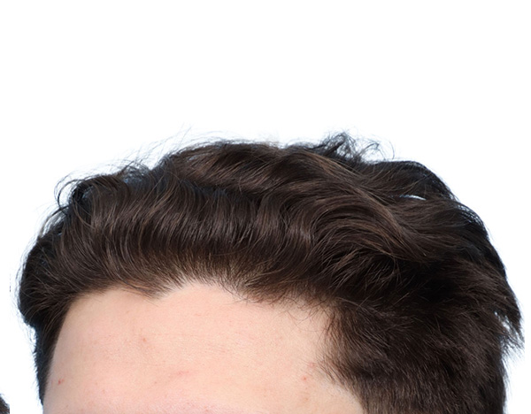 Prp Before and After | Dr. Jeffrey Wise