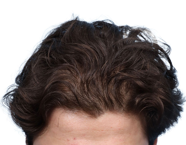 Prp Before and After | Dr. Jeffrey Wise