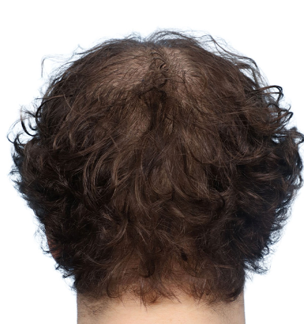 Prp Before and After | Dr. Jeffrey Wise