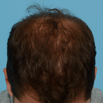 Prp Before and After | Dr. Jeffrey Wise