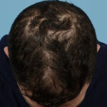 Prp Before and After | Dr. Jeffrey Wise