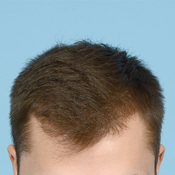 Prp Before and After | Dr. Jeffrey Wise
